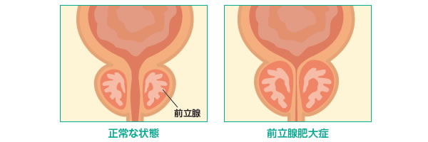 よくみられるこんな症状は前立腺肥大症かもしれません